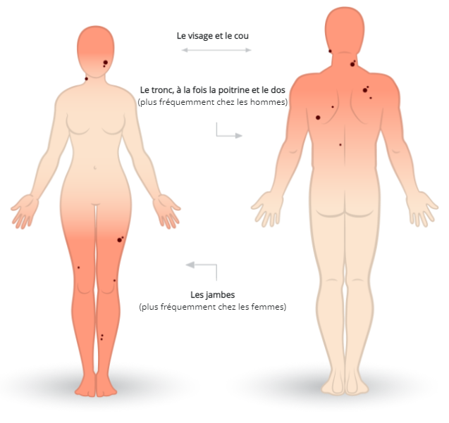 man and woman with melanoma