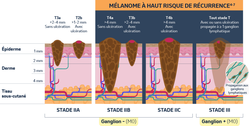 MÉLANOME À HAUT RISQUE DE RÉCURRENCE