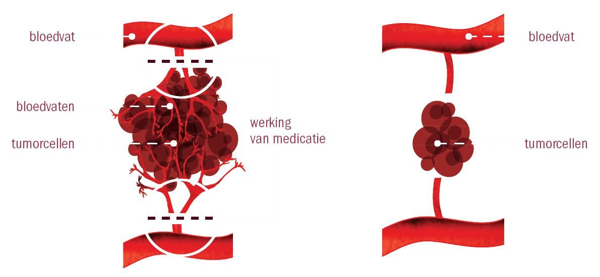angiogeneseremmers