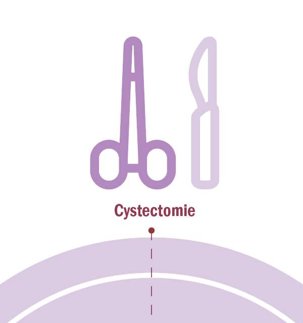 Cystectomie