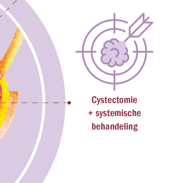 Cystectomie + systemische behandeling